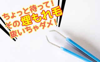 埋もれ毛（埋没毛）は抜かないで！埋もれ毛の正しい対処法と予防法解説